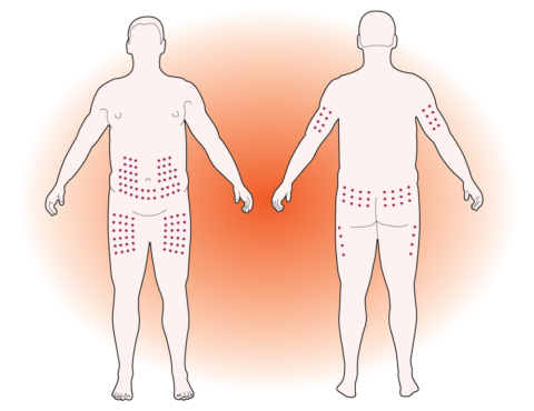 Diabetes injection - good locations on the body include the abdomen, the buttocks and outer thighs, and the back of the upper arms